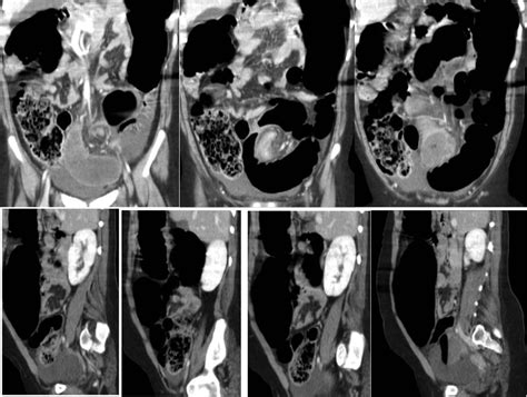 Sigmoid Volvulus In An Adolescent Girl Staged Management With