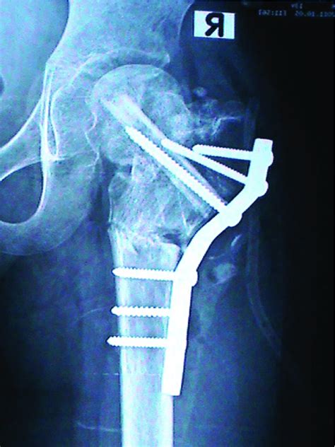 Fibular Strut Grafts With Subtrochanteric Valgus Osteotomy Download