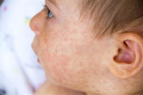 Urticaria may be confined to one part of the body (typically a rash on the face) or. Baby With Dermatitis Problem Of Rash. Allergy Suffering ...