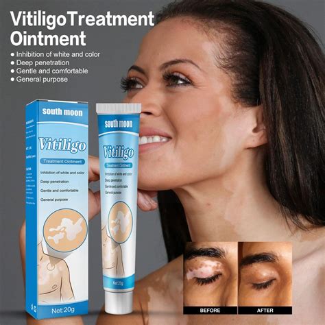 20g Herbal Extract White Spot Disease Cream Vitiligo Ointment Shopee