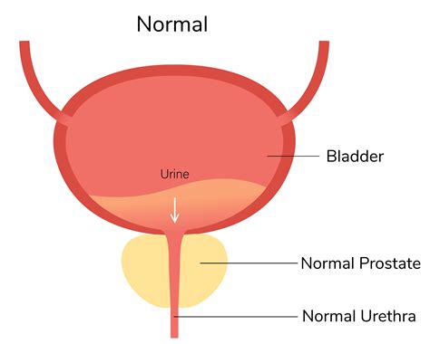 How An Enlarged Prostate Affects Your Sexual Health Menmd