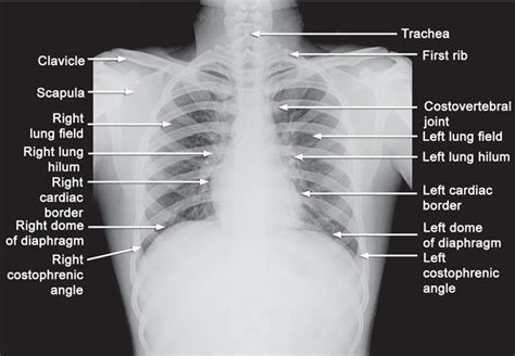 Study Medical Photos Simplified Approach To Reading Chest X Rays