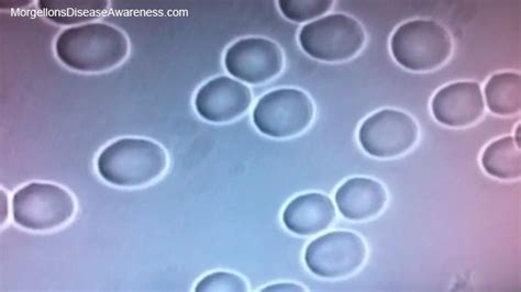 Morgellons Disease Awareness Live Blood Microscopy In A Person
