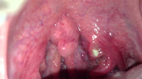 White Spots Back Throat Teen Porn Tubes