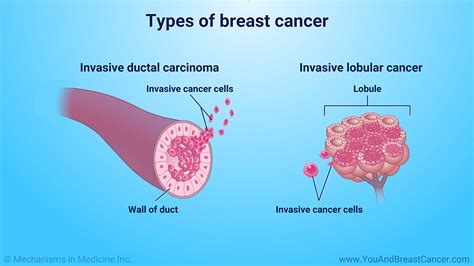 Slide Show Understanding Breast Cancer