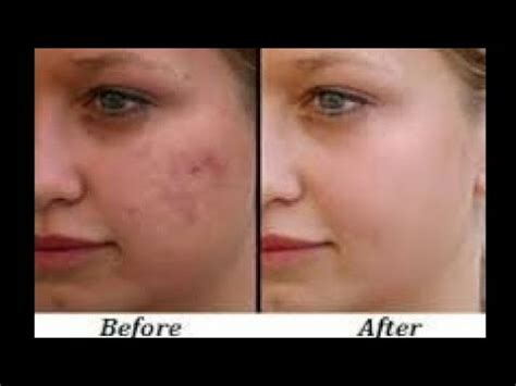 Please be careful with your skin and your health! Chemical Peel At Home / Chemical Peel for Acne & Scars For ...