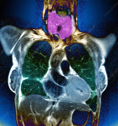 Swollen Thyroid Gland Mri Scan Stock Image M1650294 Science