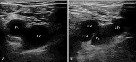 Ultrasound Guided Central Venous Access The Basics Radiology Key