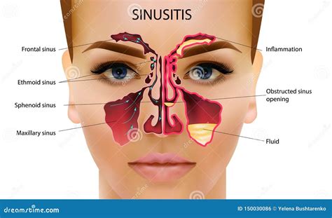 Sinusitis Healthy And Sinus Infections Signs Realistic Illustration For Medical Posters And