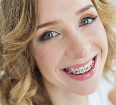 Pin De Shrood Burgos Em Braces Sorriso Dentes Aparelho De Dente Ortodôntico