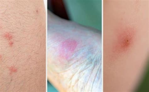 Bug Bite Comparison Fleas Vs Bed Bugs Vs Mosquitoes