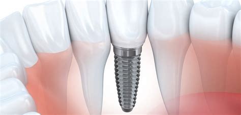 The Dental Implant Healing Stages In Detail