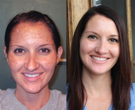 Vitamin c supplements usually contain the vitamin in the form of ascorbic acid (it has equivalent bioavailability to that of ascorbic acid that occurs naturally these supplements have benefits for the skin (face, especially) and overall health as well. My Skin Transformation: Before & After | Obagi skin care ...
