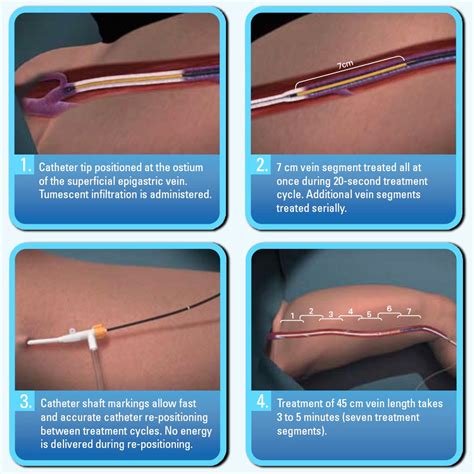 Treatments Without Surgery The British Vein Institute