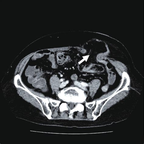 Preoperative Ct Scan Revealed The Parastomal Hernia And The Omentum As