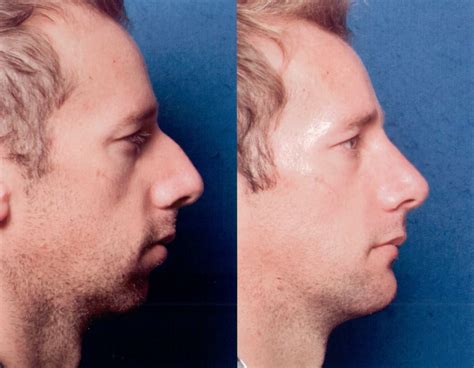 The Nose Clinic Before And After Nose Surgery Photos 59