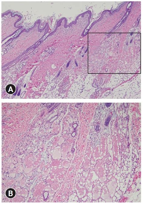 Cutaneous Angiomatosis In A Dog A Case Report