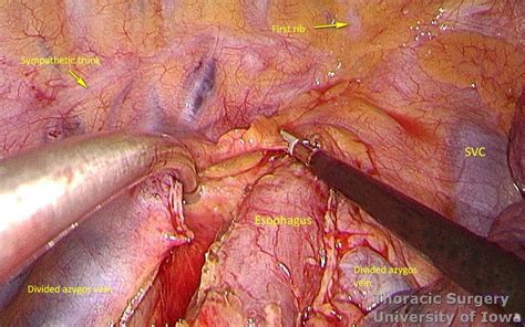 • right vats, laparotomy and neck incision • laparotomy for gastric mobilization. Esophagectomy: Three-field (McKeown) - Laparotomy and ...