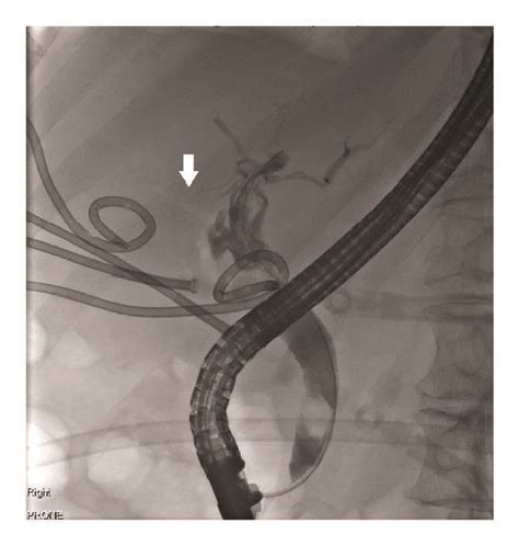 Cholangiogram At Ercp Showing An 8 Mm Common Bile Duct Stone With