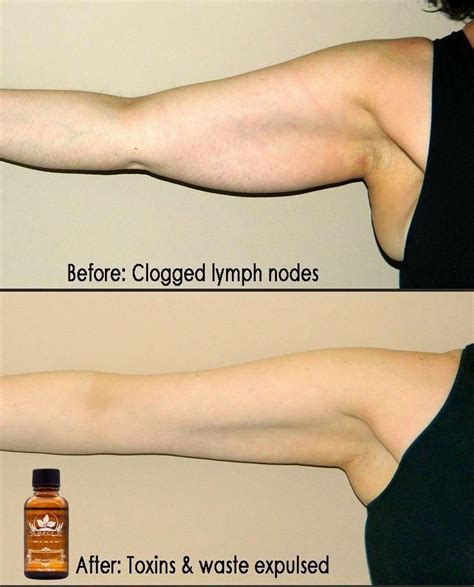 Lymph Drainage Methods And Benefits