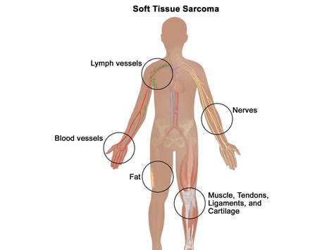 Soft Tissue Sarcoma—patient Version Nci