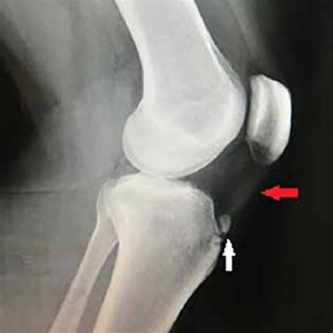 Lateral Knee Radiography Mild Opacity In The Trace Of Patellar Tendon