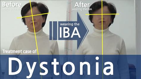 Dystonia Cervical Dystonia Spasmodic Torticollis 사경증 치료 근긴장이상증