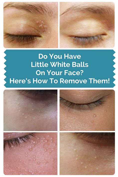 Do You Have Little White Balls On Your Face Heres How To Remove Them