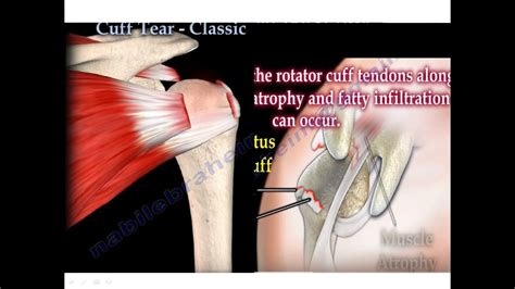 Massive Rotator Cuff Tears Orthopaedicprinciples Com