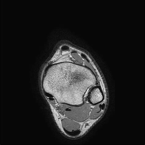Normal Footankle Mri Axial View 1 Diagram Quizlet