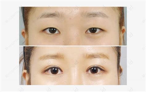 How To Apply Eye Makeup After Eyelid Surgery Saubhaya Makeup