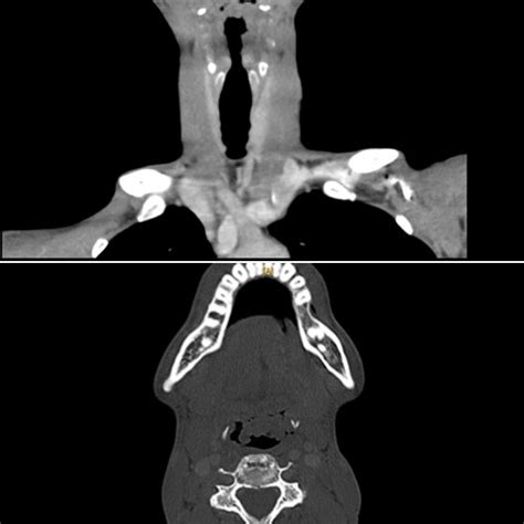 Cervical Computed Tomography Showing Diffuse Supraglottic Laryngeal