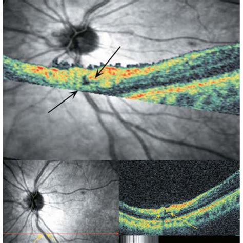 Differentiation Between Dense Cortical Vitreous Or Epiretinal Membrane