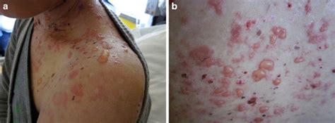 Bullous Systemic Lupus Erythematosus A Review And Update To Diagnosis