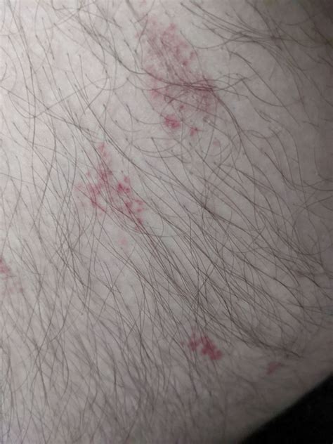 Rash On My Legs Dermatology Forums Patient