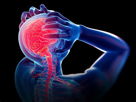 Migraine Linked To Cervical Artery Dissection