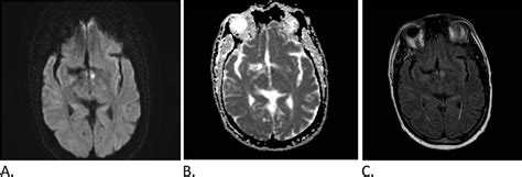 Isolated Mammillary Body Infarct Causing Global Amnesia A Case Report