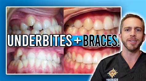 Underbite Braces Treatment Before And After Youtube