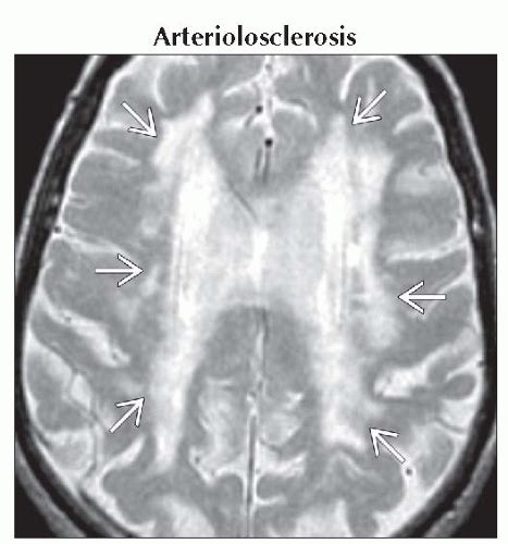 Confluent White Matter Lesions Neupsy Key