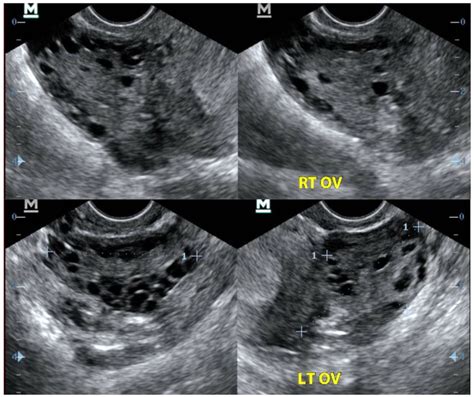 Transvaginal Pelvic Ultrasound Transverse And Sagittal Images Of Right