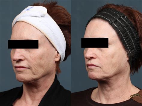 Pico Genesis Laser Treatment Before And After Photos Patient 682