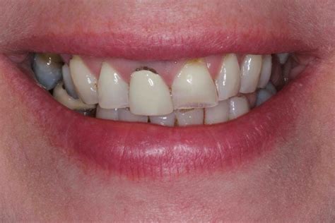 Dental Implants Preston Lancashire Replacement Teeth Implant Dentists