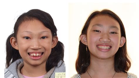 兒童牙齒矯正案例二 | 洛杉磯齒顎矯正專科-牙齒矯正