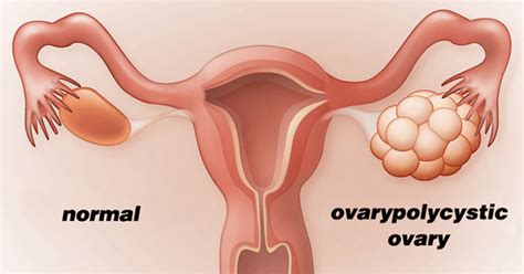 Polycystic Ovary Syndrome Pcos Dr Sita Sharma Mbbs Md