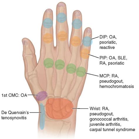 Sites Of Hand Or Wrist Involvement And Their Potential Disease