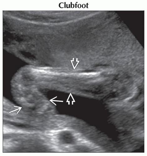 Clubfoot is a fairly common birth defect and is usually an isolated problem for an otherwise healthy newborn. Abnormal Foot | Obgyn Key