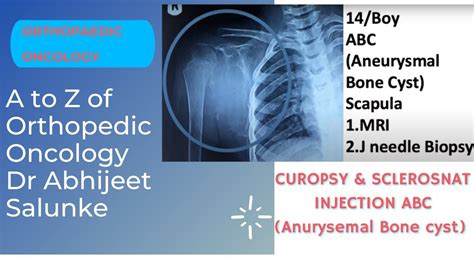 Polidocanol Sclerotherapy For Aneurysmal Bone Cyst ABC Bone Tumor Curopsy And Sclerosant