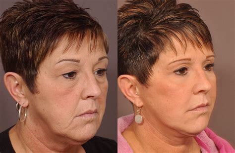 Injectable Treatments Vs Traditional Facelift Surgery Which Option Is