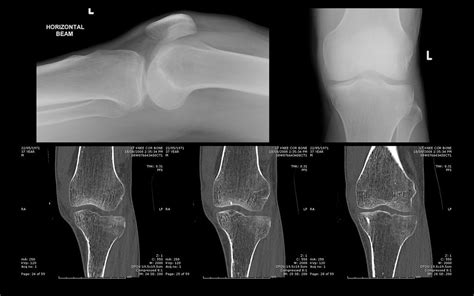 Knee Lipohaemarthrosis From Occult Tibial Plateau Fracture Flickr