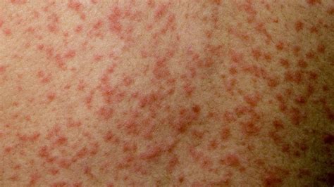 Measles Cases In Uk 2024 Eartha Renell
